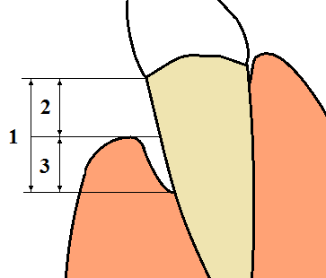 נסיגת חניכיים